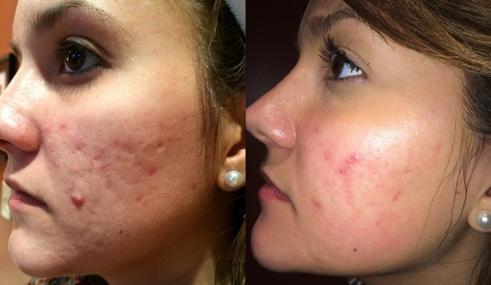 Chemical Peel Treatment in Vijayanagar
