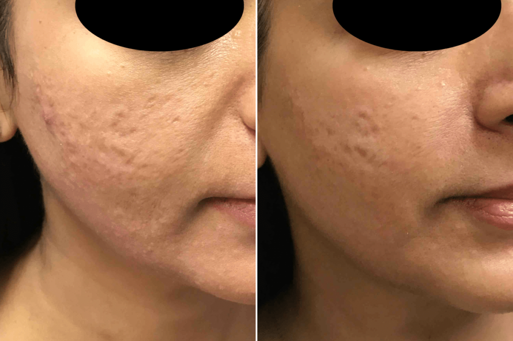 Acne Scar Removal in Vijayanagar