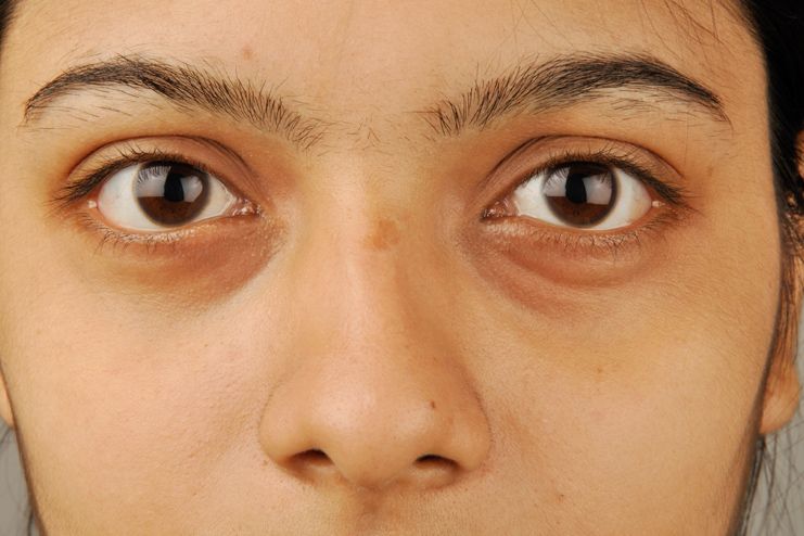 Glutathione Injections Treatment in Vijayanagar