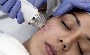 Acne Scars Treatment in Nagarabhavi