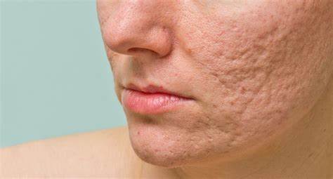 Pimple Scar Treatment in Nagarabhavi