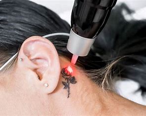 Tattoo removal in Nagarabhavi