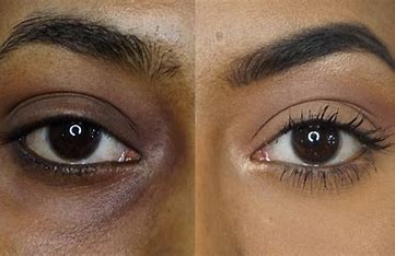 Dark Circle Treatment in Vijayanagar