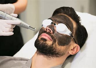 Carbon Laser Peel Treatment in Vijayanagar
