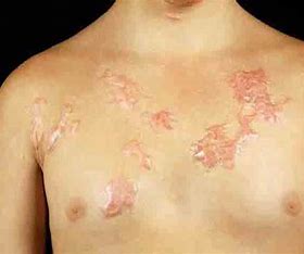 keloids Treatment in Vijayanagar