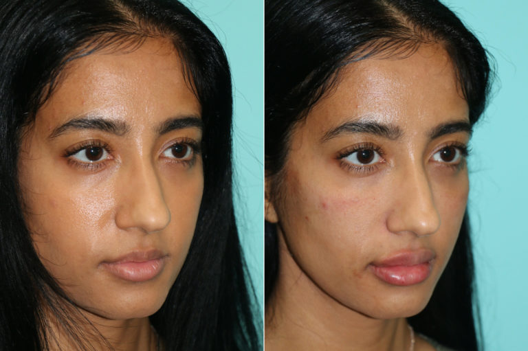 Vampire Face Lift Treatment in Vijayanagar