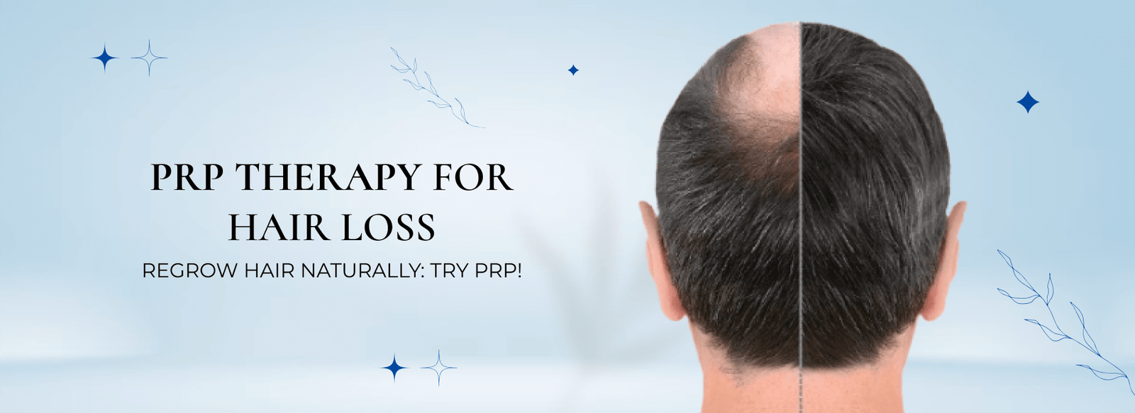 PRP therapy for Hair loss
