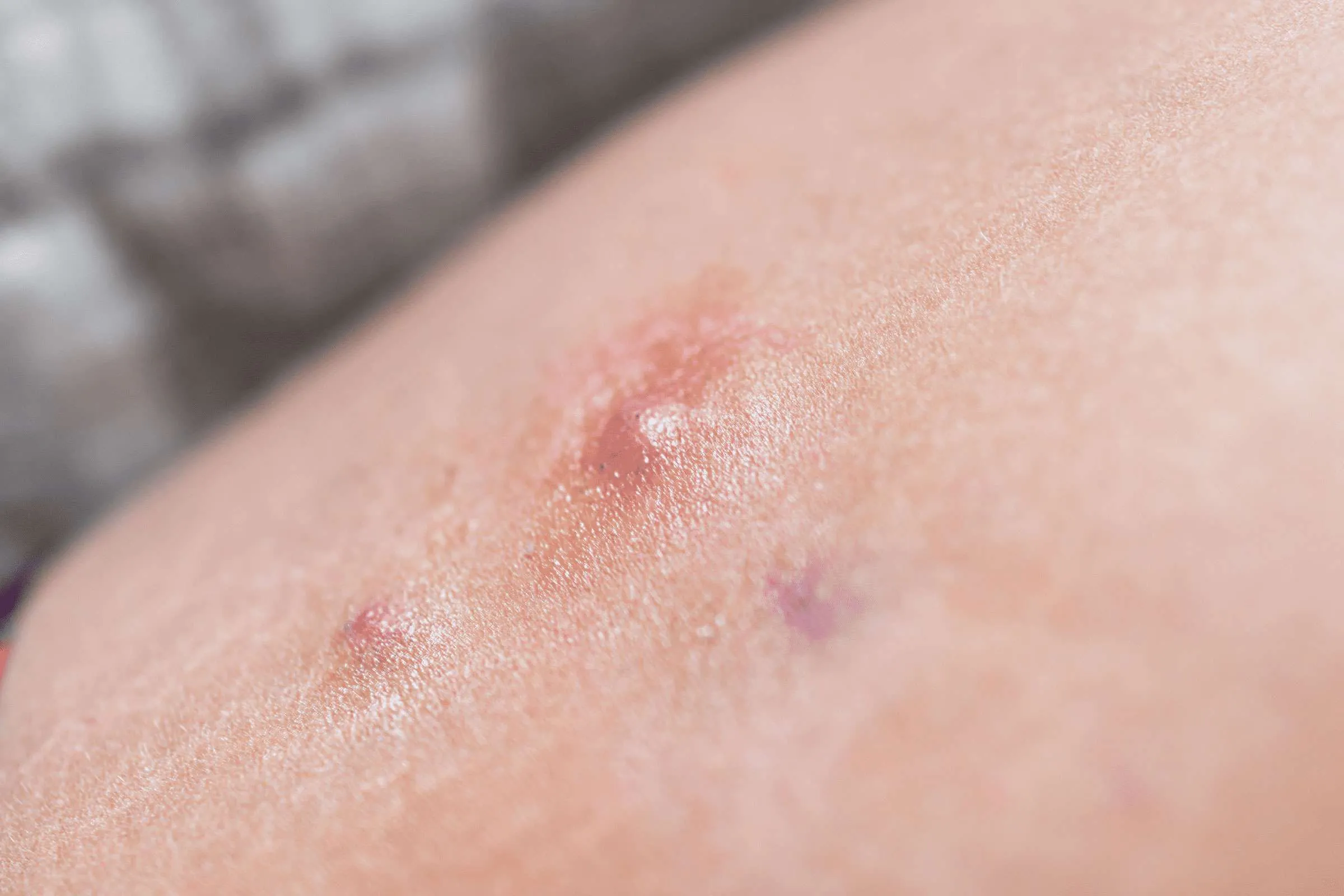 Treatment for Hidradenitis Suppurativa